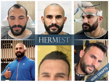 Best top 11 hair transplant clinics in Turkey: Everything you need to know