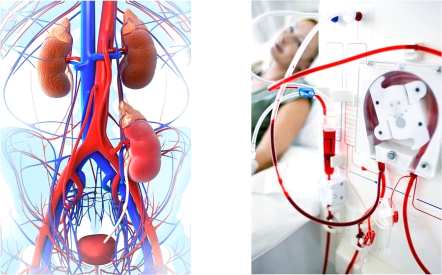 Dialysis or kidney transplantation – which one is better?