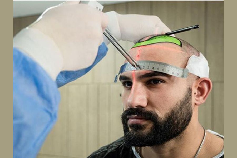 Top 3 best hair transplant clinics in Turkey