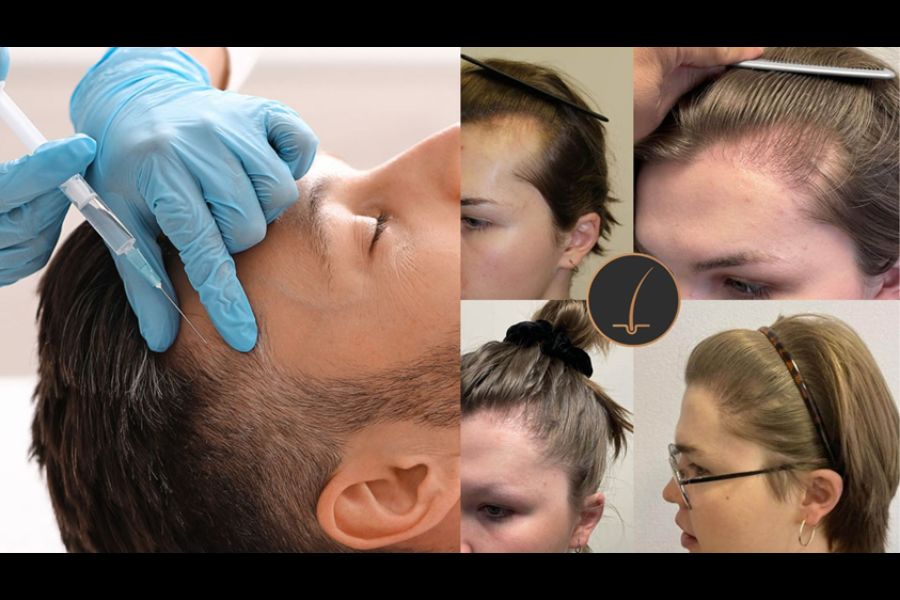 Hair Transplant Costs - in the UK & Abroad | Qunomedical