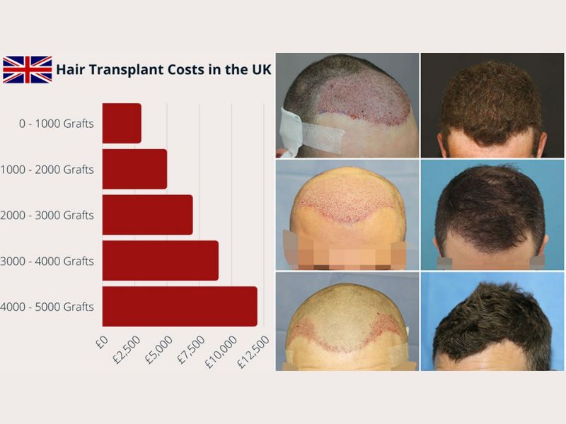 Hair transplant in UK, how to choose the best option?